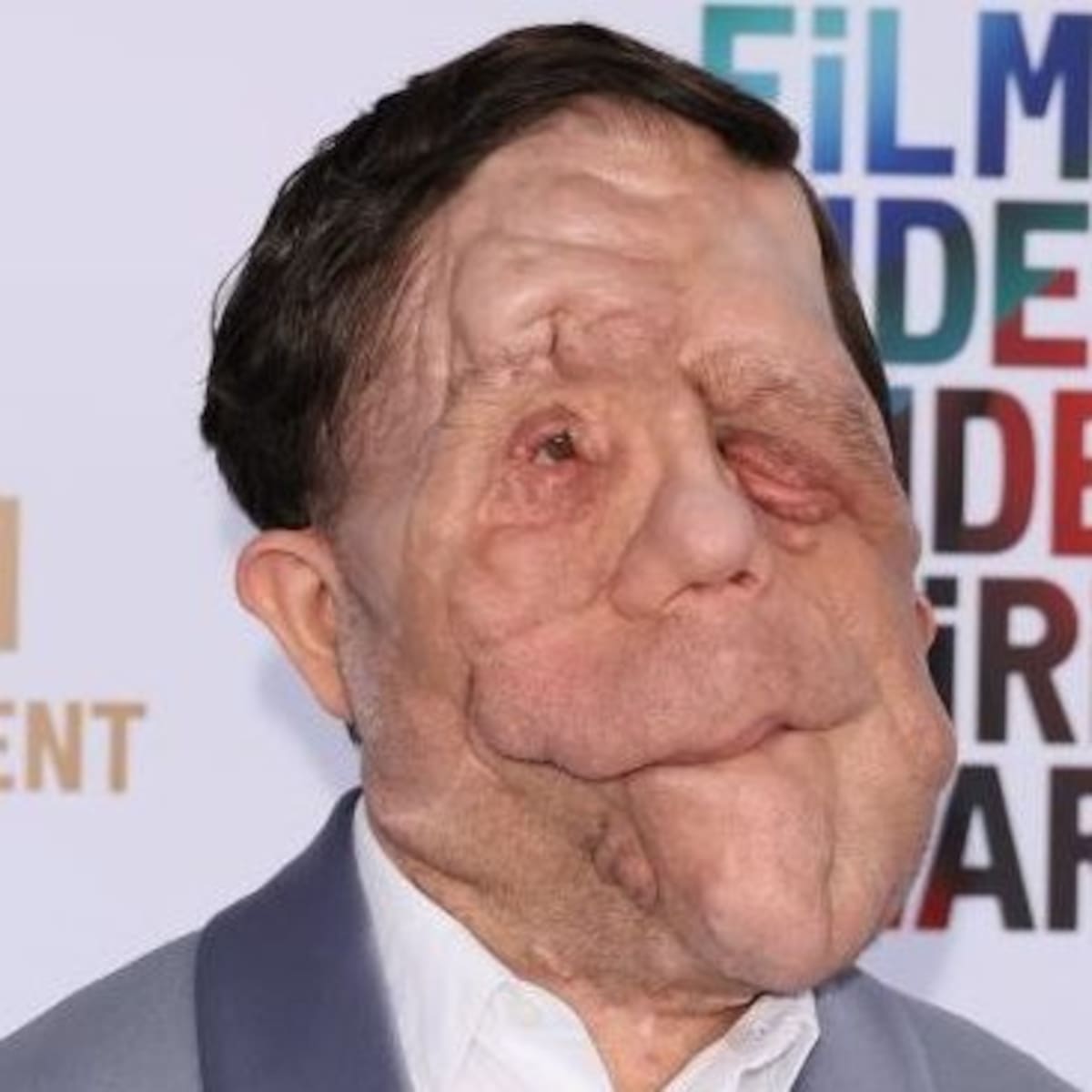 What Is Neurofibromatosis? Adam Pearson’s from ‘A Different Man’ Real Condition